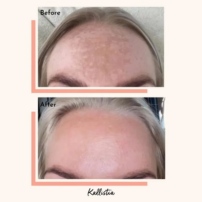 Capsules de nettoyage pour hyperpigmentation